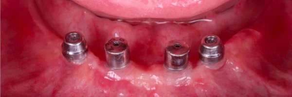 antes-da-cirurgia-de-implante-dental.webp