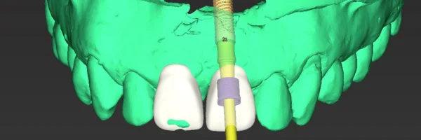 antes-da-cirurgia-guidada-por-computador-para-implante-dental.webp