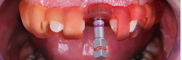 depos-da-cirurgia-guidada-por-computador-para-implante-dental.webp